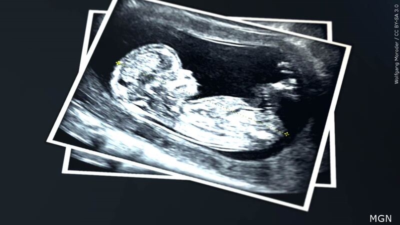 Sonogram photo